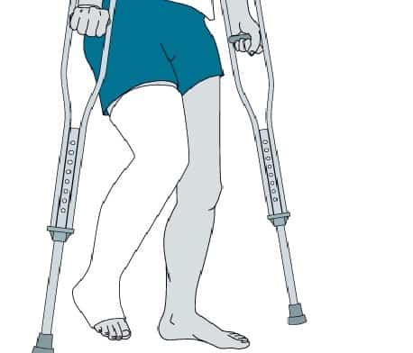 prelom noge gips prelom potkolenice