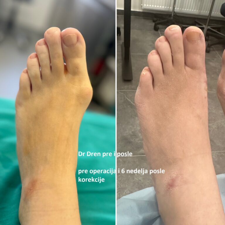 čukljevi čukalj operacija korekcija dr dren stopalo pre i posle da li se čukljevi vraćaju - Dr Dren čukljevi čukalj operacija korekcija dr dren stopalo pre i posle da li se čukljevi vraćaju