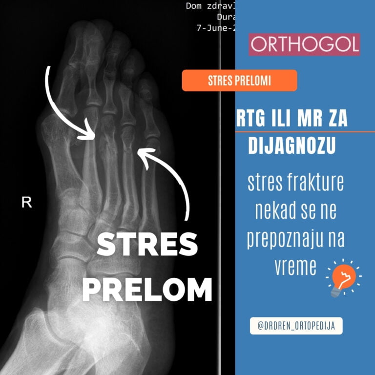 stres prelom stres frakture stres prelomi kosti